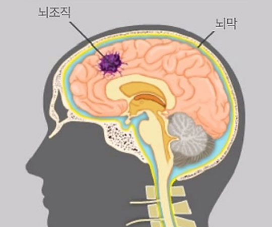 원발성 뇌종양 